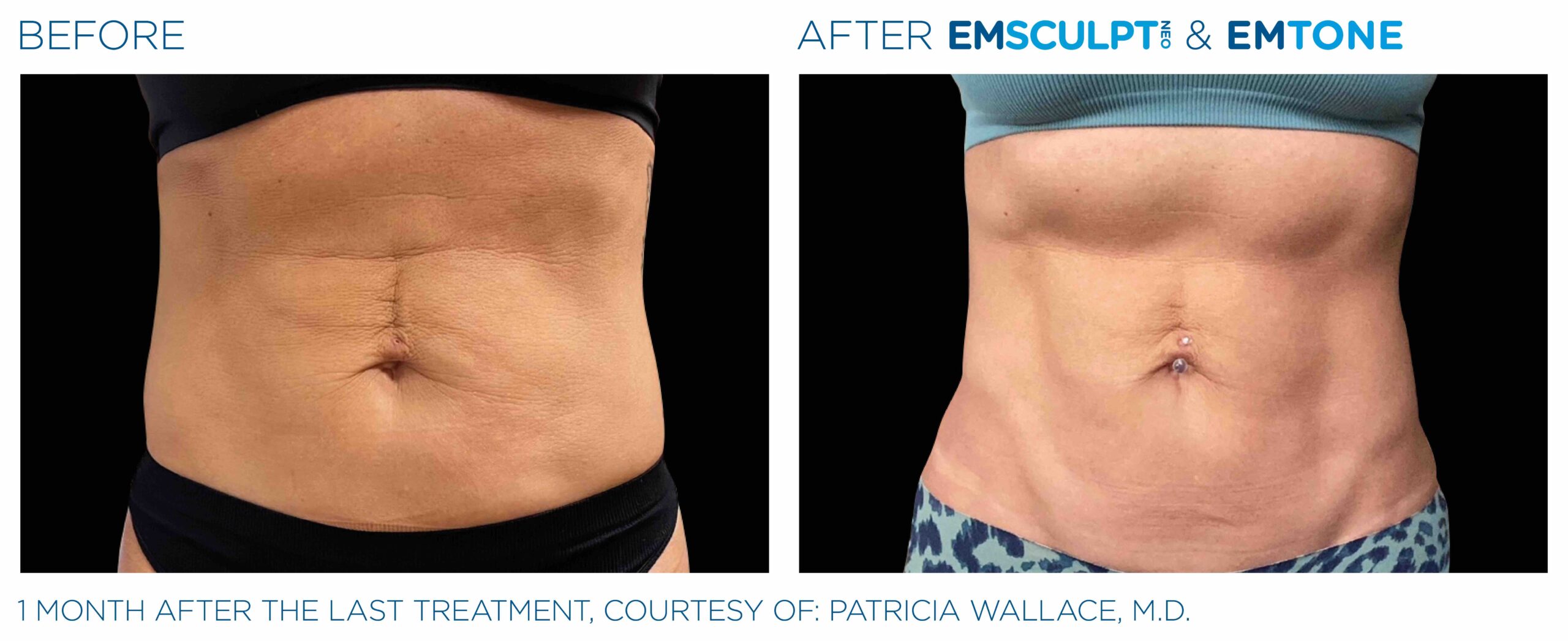 Emsculpt_Neo-Emtone_PIC_Ba-card-female-abdomen-001_ENUS100