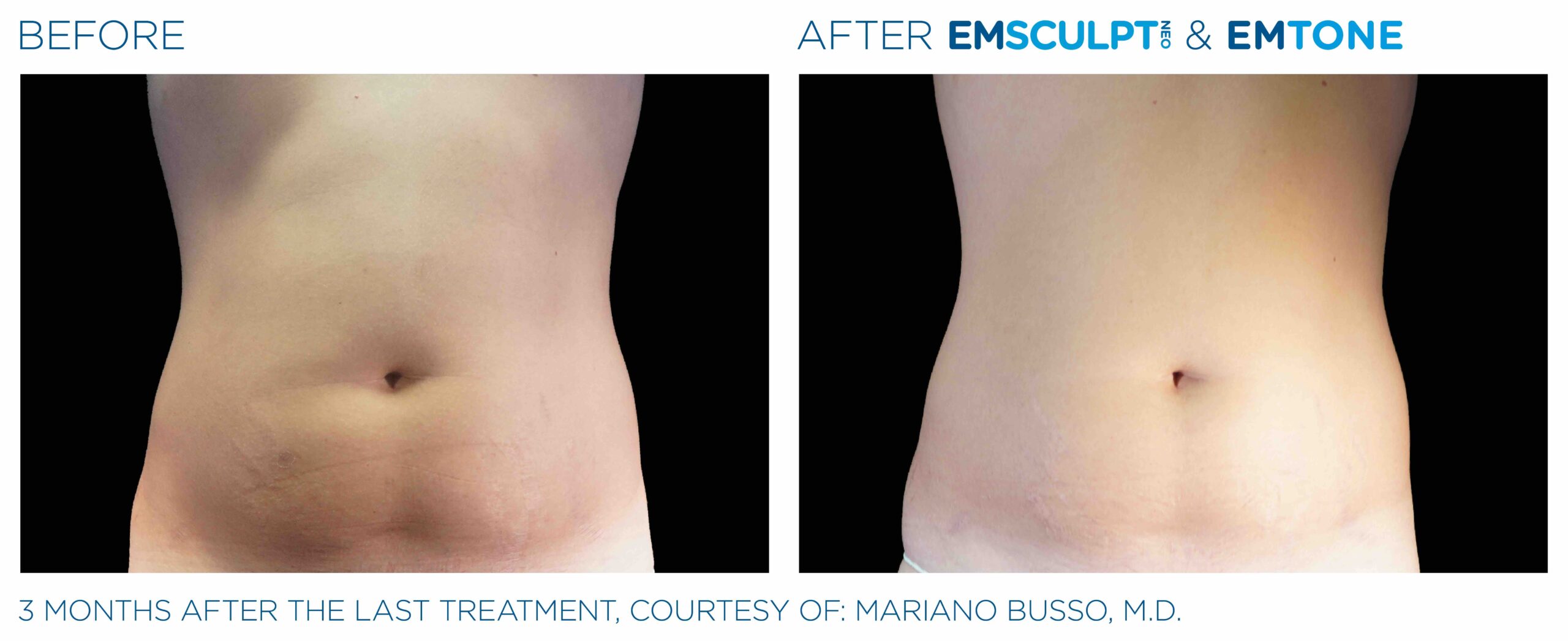 EMSculpt Neo, Aura Boulder Plastic Surgery