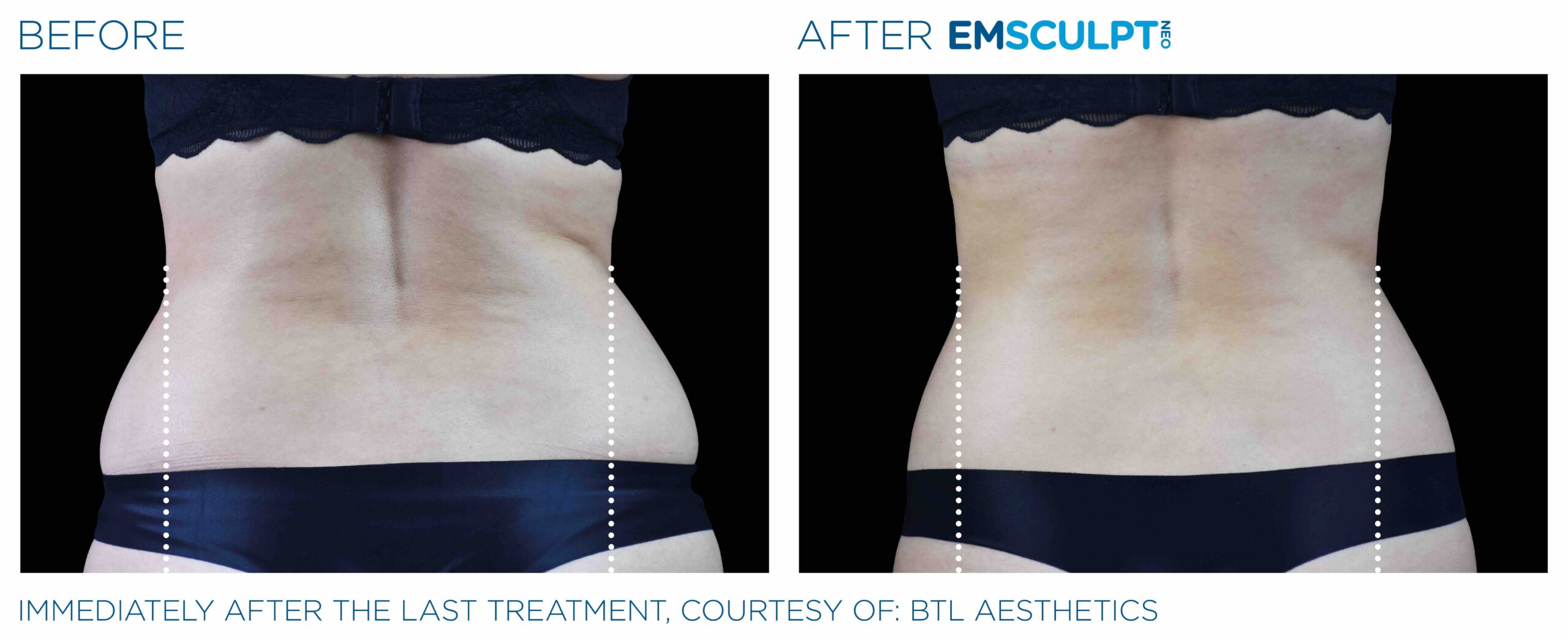 Emsculpt_Neo_PIC_Ba-card-female-lateral-abdomen-101_ENUS100