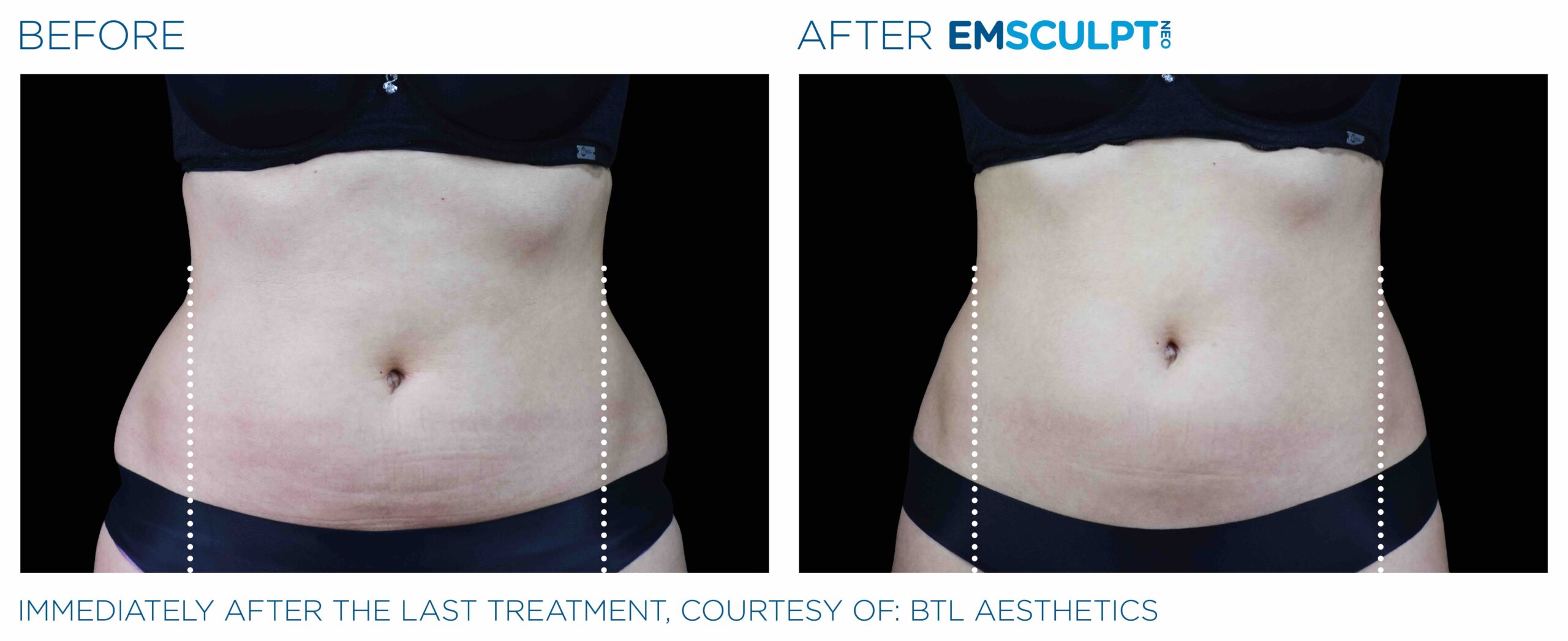 Emsculpt_Neo_PIC_Ba-card-female-lateral-abdomen-102_ENUS100