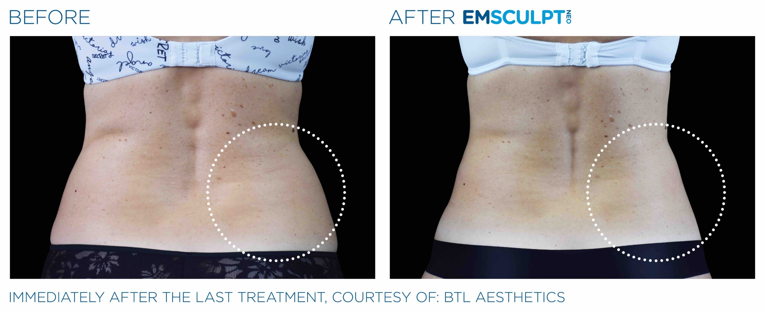 EmSculpt Neo Body Shaping Coral Gables FL, Miami.