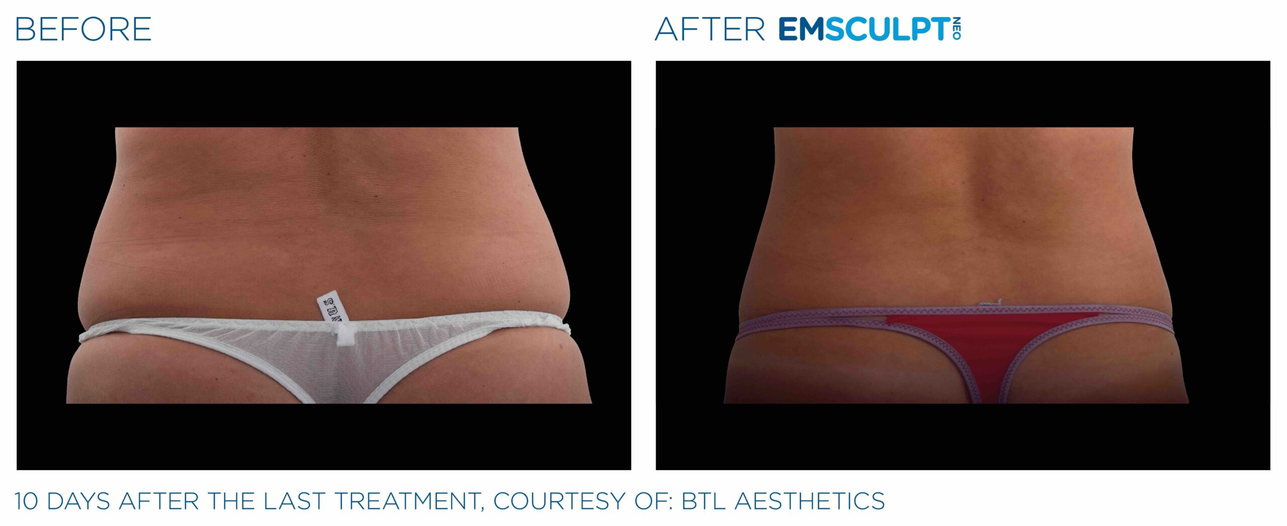 Emsculpt_Neo_PIC_Ba-card-female-lateral-abdomen-104_ENUS100