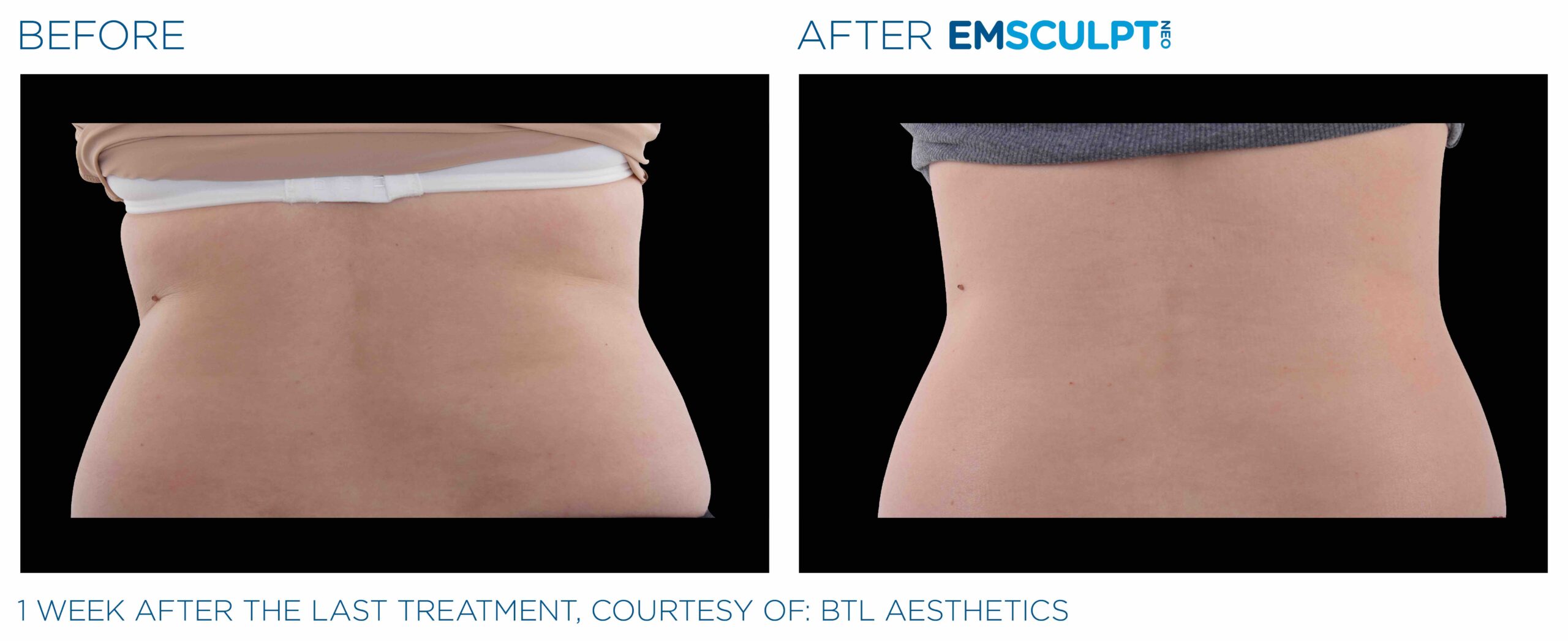 EMSculpt Neo, Aura Boulder Plastic Surgery