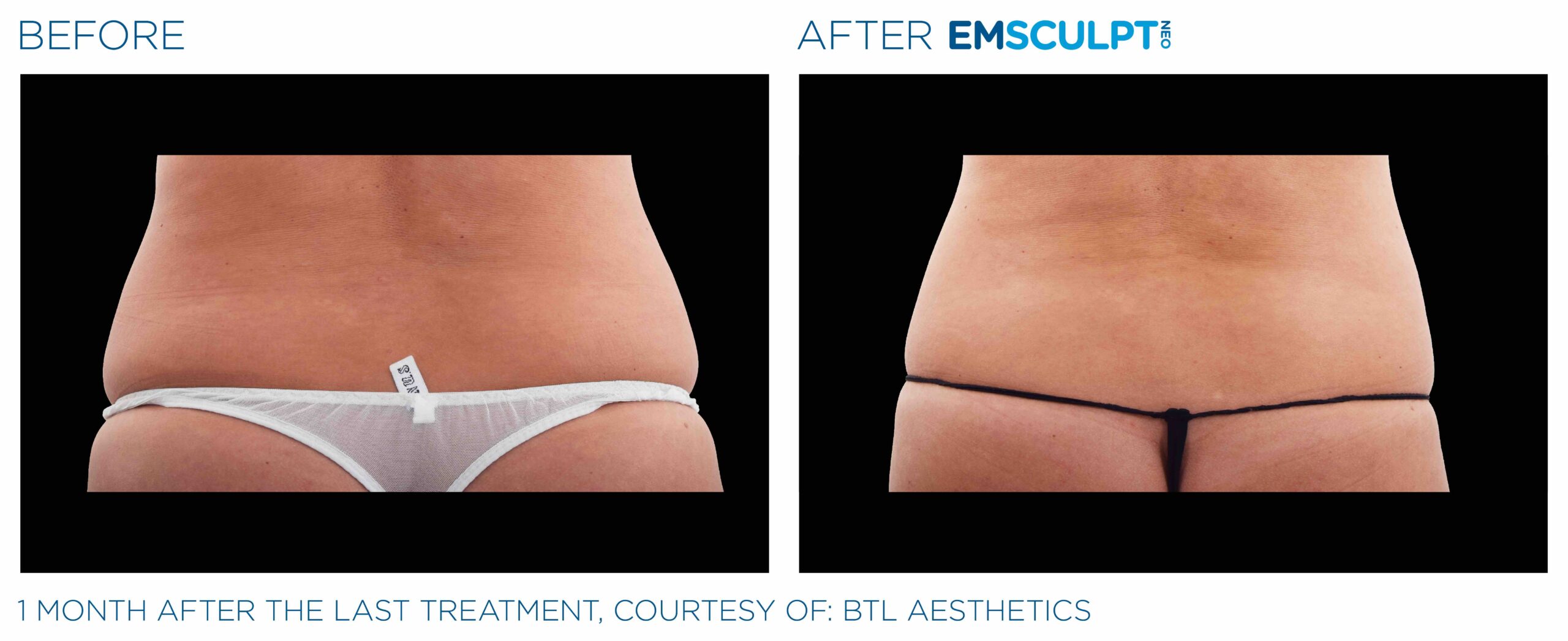 Emsculpt_Neo_PIC_Ba-card-female-lateral-abdomen-113_ENUS100