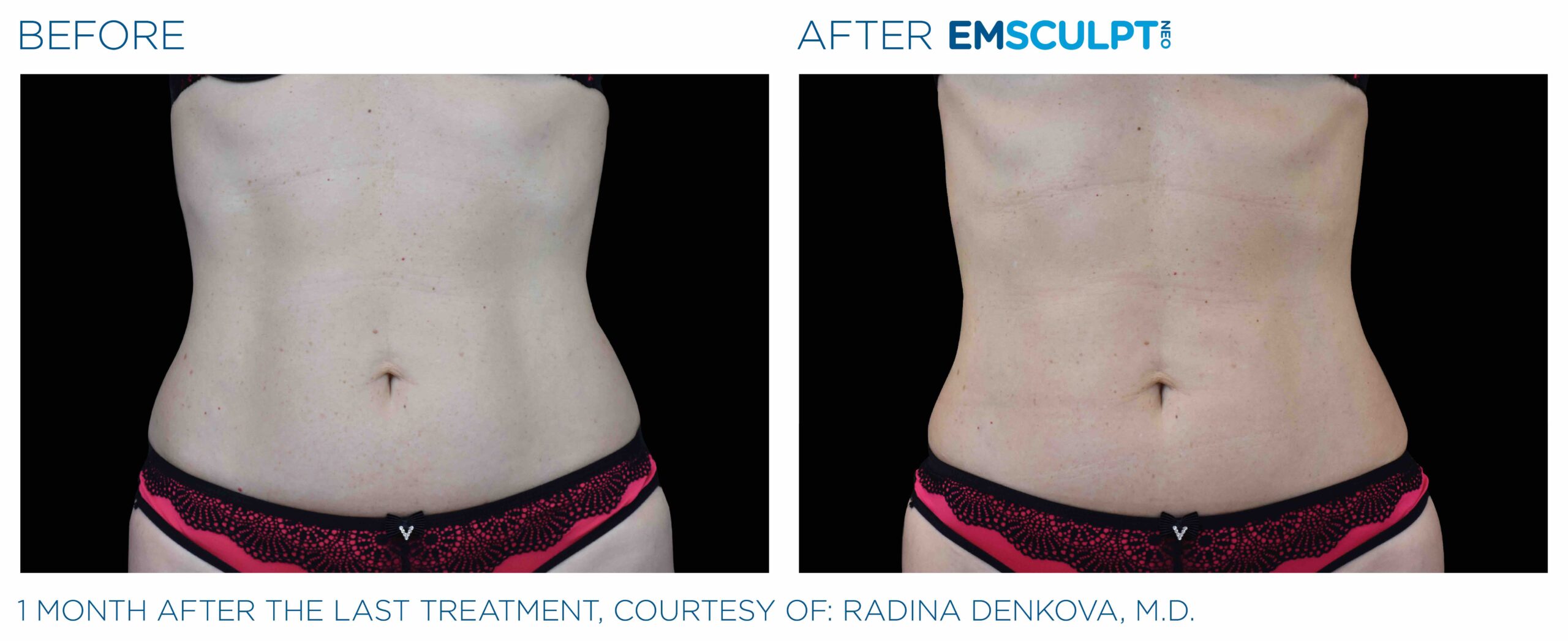 Emsculpt Neo Coral Springs - Build Muscle & Reduce Fat - No Surgery or  Downtime. Ripped Abs, Shaped Buttocks & Biceps.