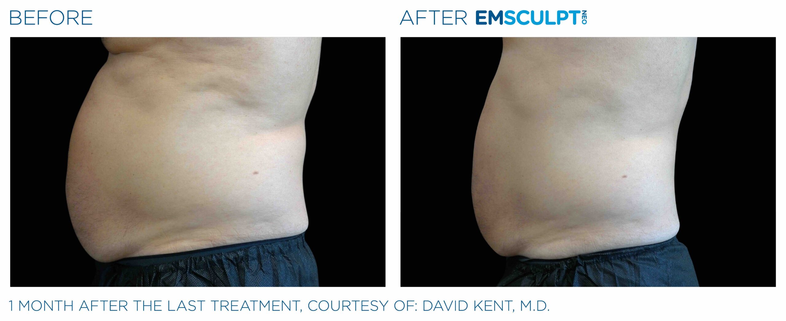 Emsculpt_neo_PIC_Ba-card-male-abdomen-002_ENUS100