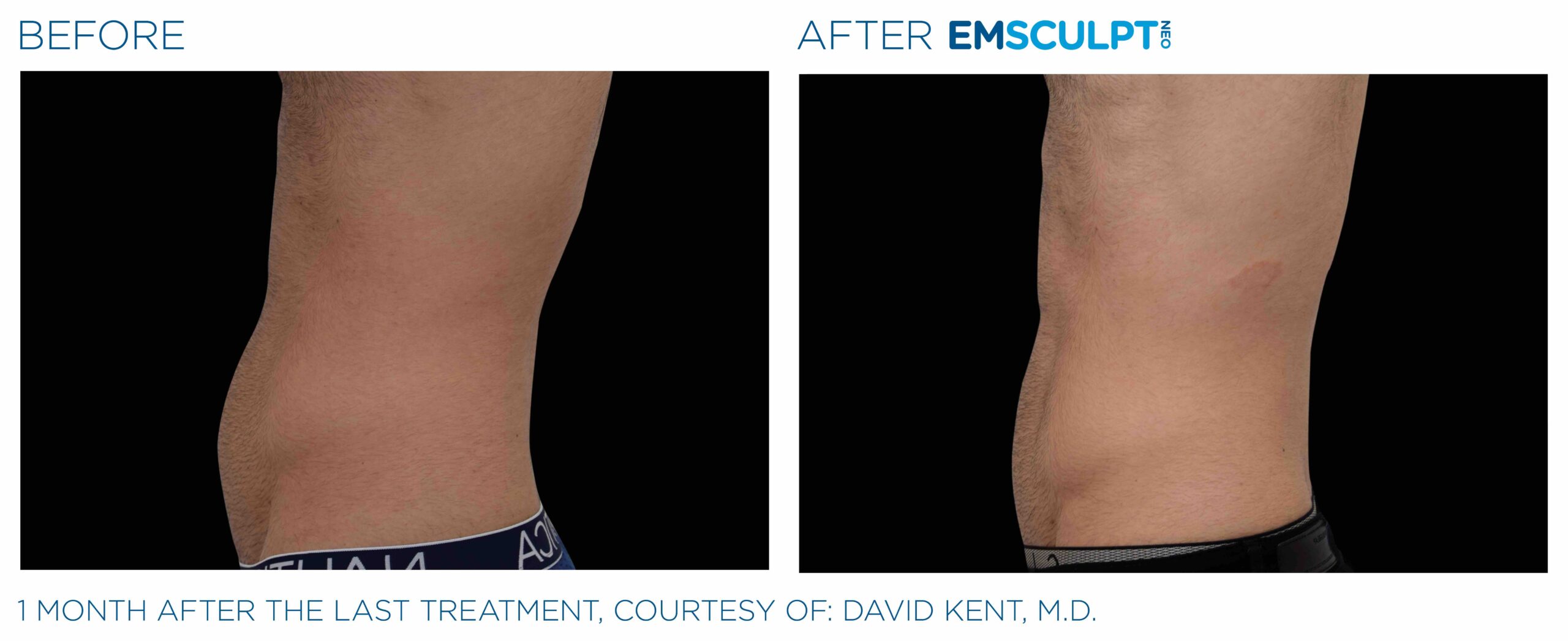 Emsculpt_neo_PIC_Ba-card-male-abdomen-021_ENUS100