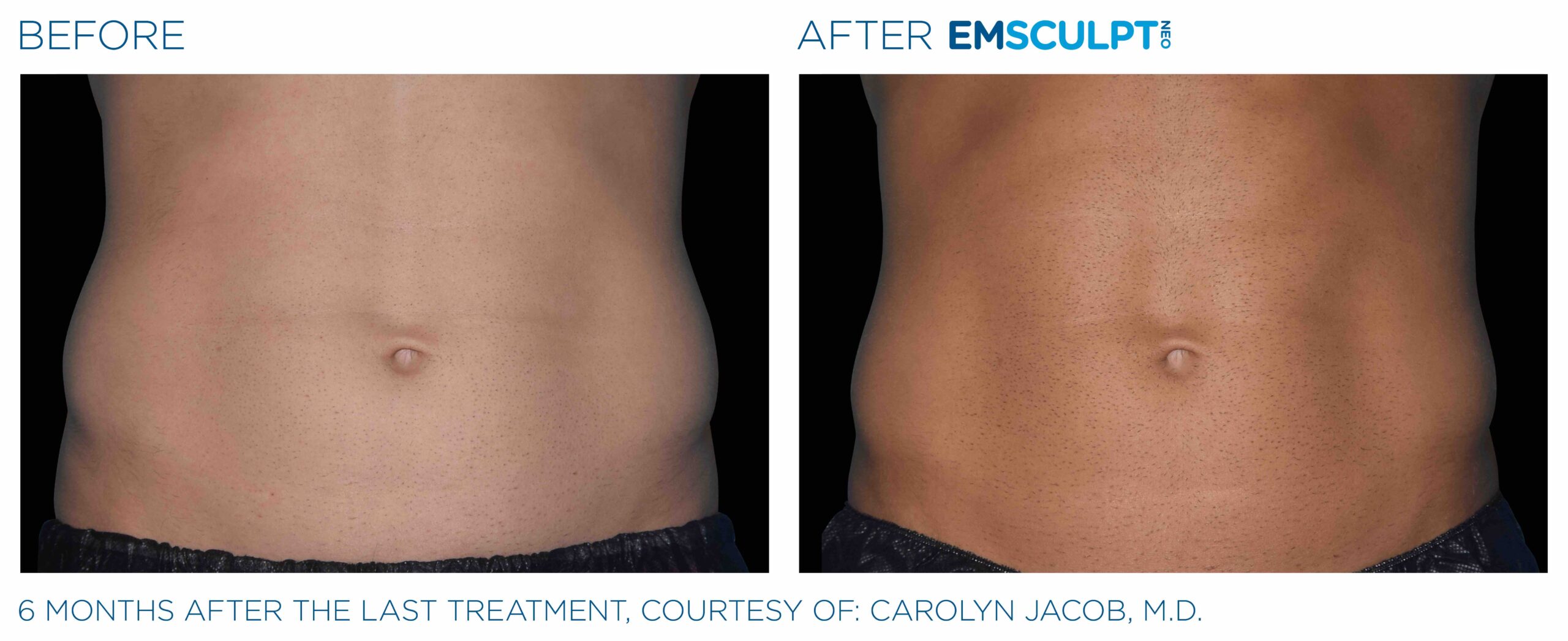 EmSculpt Neo Body Shaping Coral Gables FL, Miami.